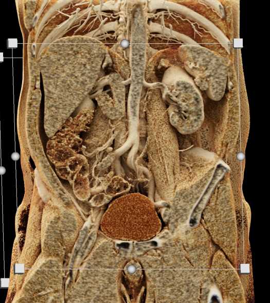 Carcinoma of the Appendix - CTisus CT Scan