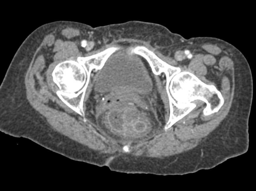 Ulcerative Colitis - CTisus CT Scan