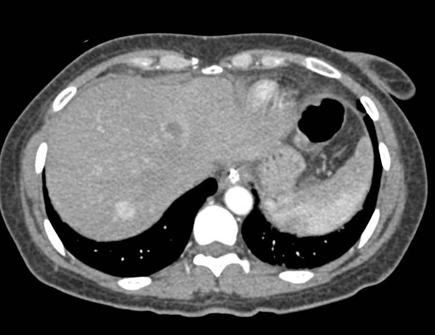 Cecal Cancer with Liver Metastases - CTisus CT Scan