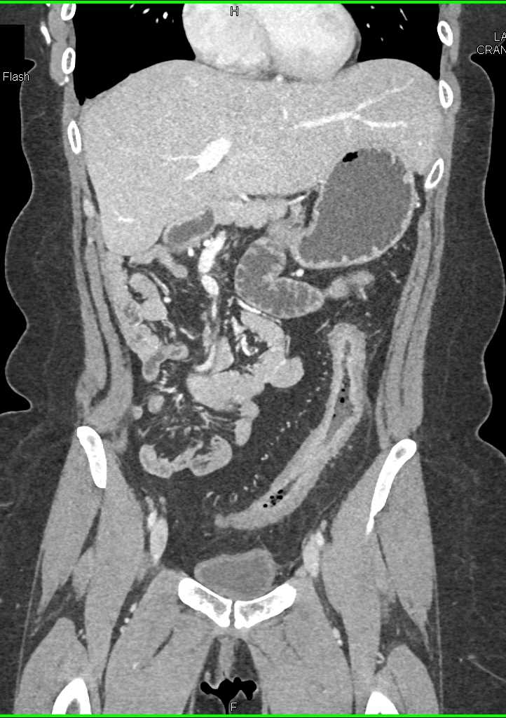 Colitis Involves the Descending Colon - CTisus CT Scan