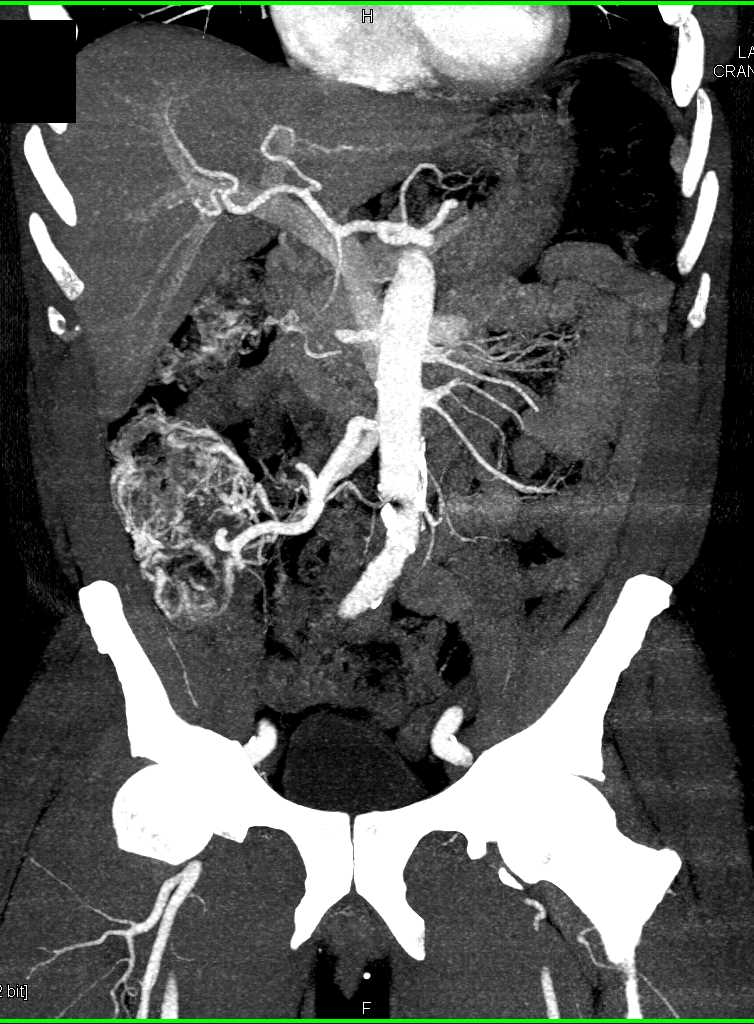Angiodysplasia Cecum - CTisus CT Scan