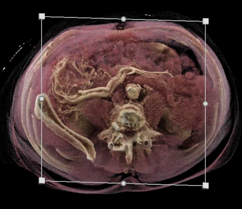 Angiodysplasia Cecum - CTisus CT Scan