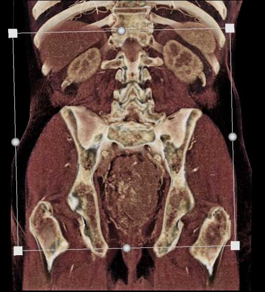 Lymphoma Encasees the Rectum - CTisus CT Scan