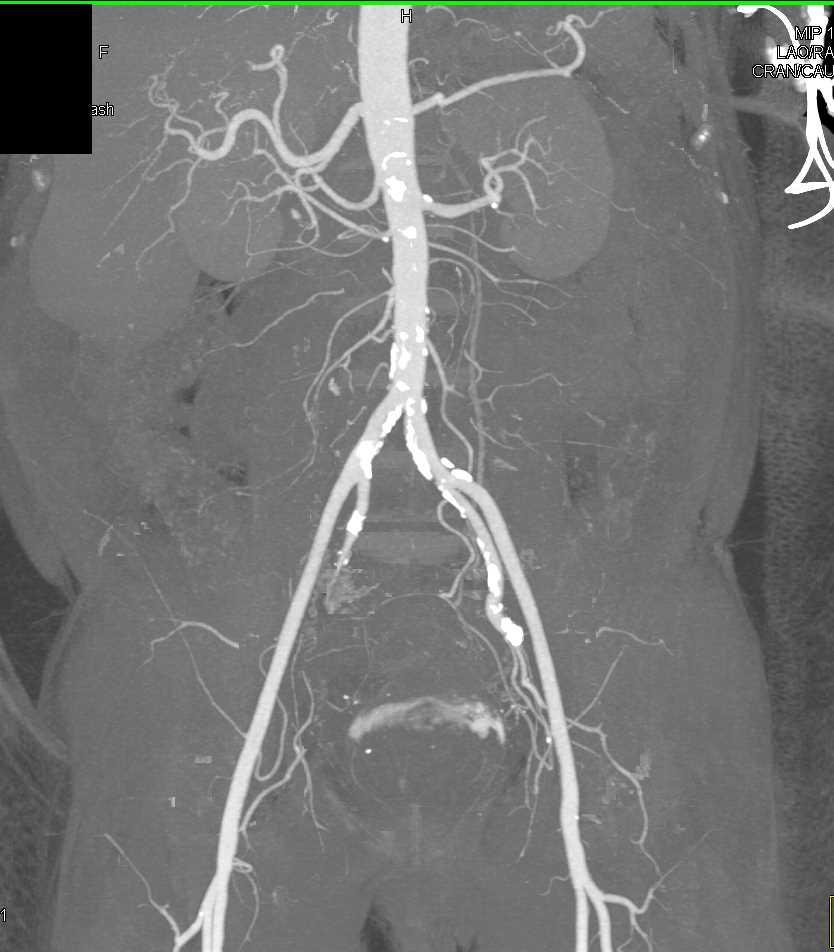 Active Rectal Bleed - CTisus CT Scan