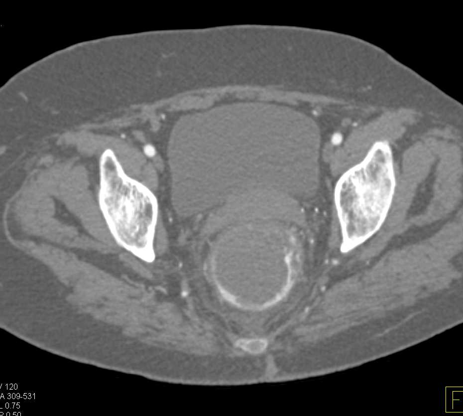Active Rectal Bleed - CTisus CT Scan
