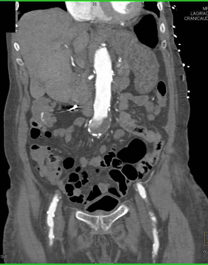 Active Bleed in the Right Colon - CTisus CT Scan