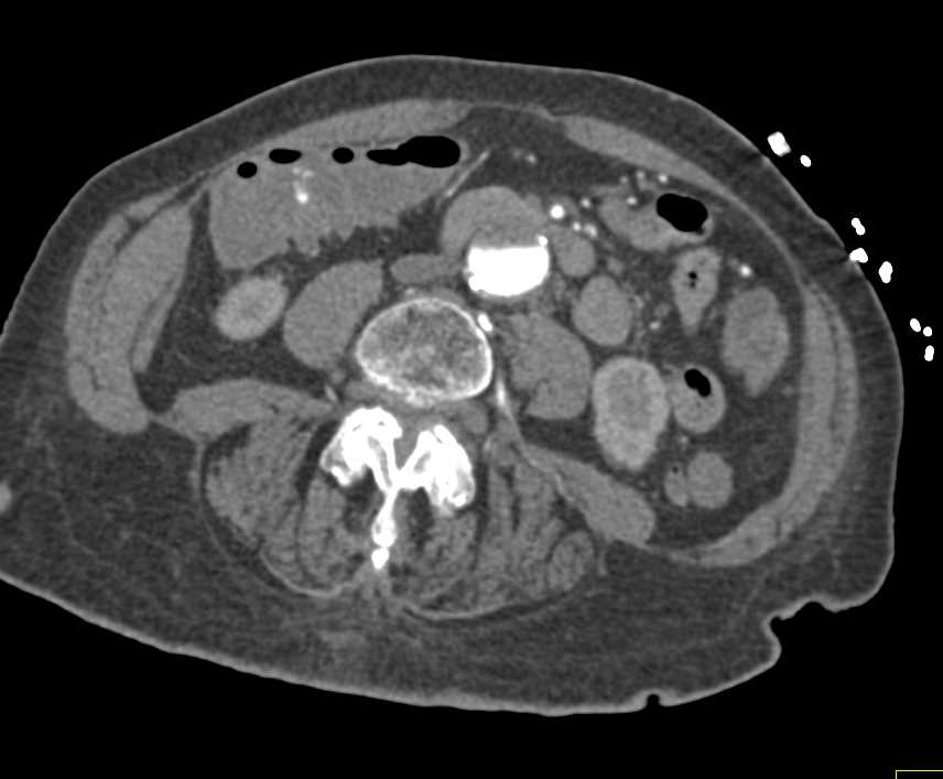 Active Bleed Ascending Colon due to Diverticular Disease - CTisus CT Scan