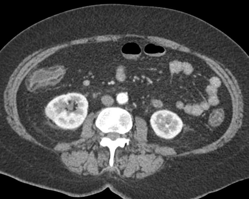 Crohns Disease - CTisus CT Scan
