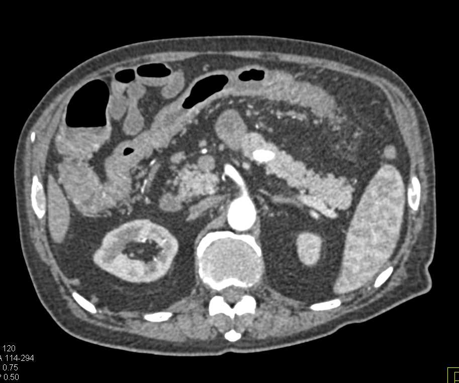 Ulcerative Colitis Especially Prominent in Transverse Colon - CTisus CT Scan