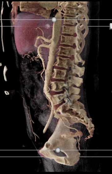 Rectal Bleed - CTisus CT Scan