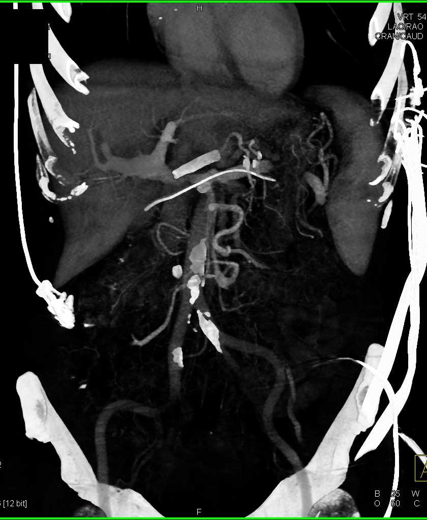 Active Bleed in the Cecum - CTisus CT Scan