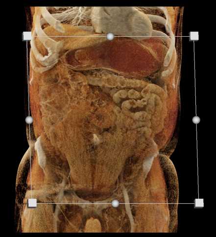 Colitis Colon - CTisus CT Scan