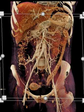 Inflammatory Colitis Involves the Descending Colon - CTisus CT Scan