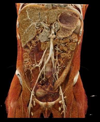 Ulcerative Colitis Involves the Sigmoid Colon - CTisus CT Scan
