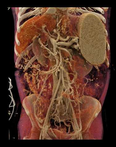 Colitis - CTisus CT Scan