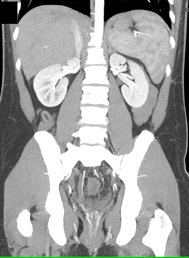 Rectal Bleed from Varices - CTisus CT Scan