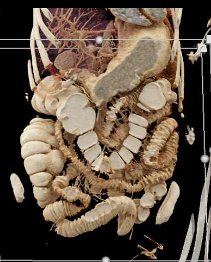 Cinematic Rendering with Positive Contrast and Crohn's Disease - CTisus CT Scan