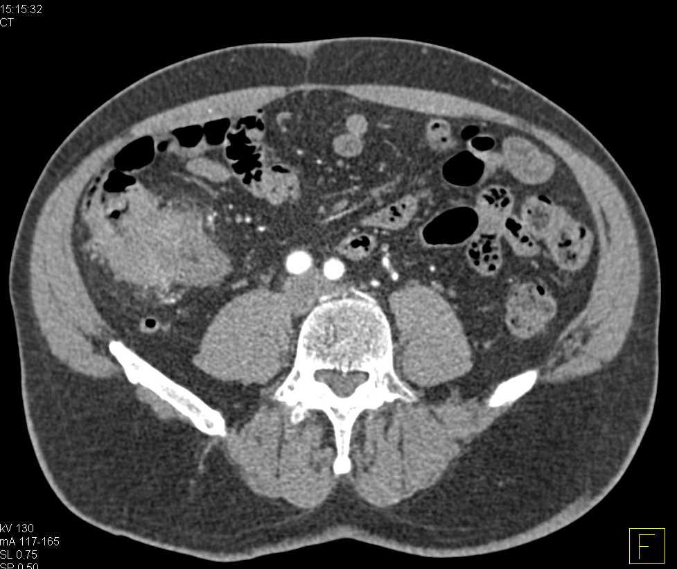 Cecal Carcinoma with Liver Metastases - CTisus CT Scan