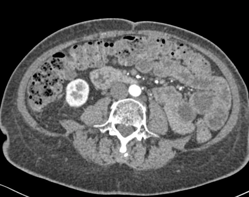 Colitis Involves Cecum - CTisus CT Scan