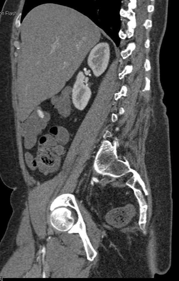 Pill in Right Colon Simulates a Bleed - CTisus CT Scan