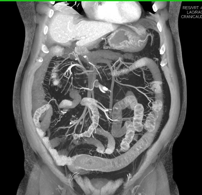 Colitis Involves the Descending Colon - CTisus CT Scan