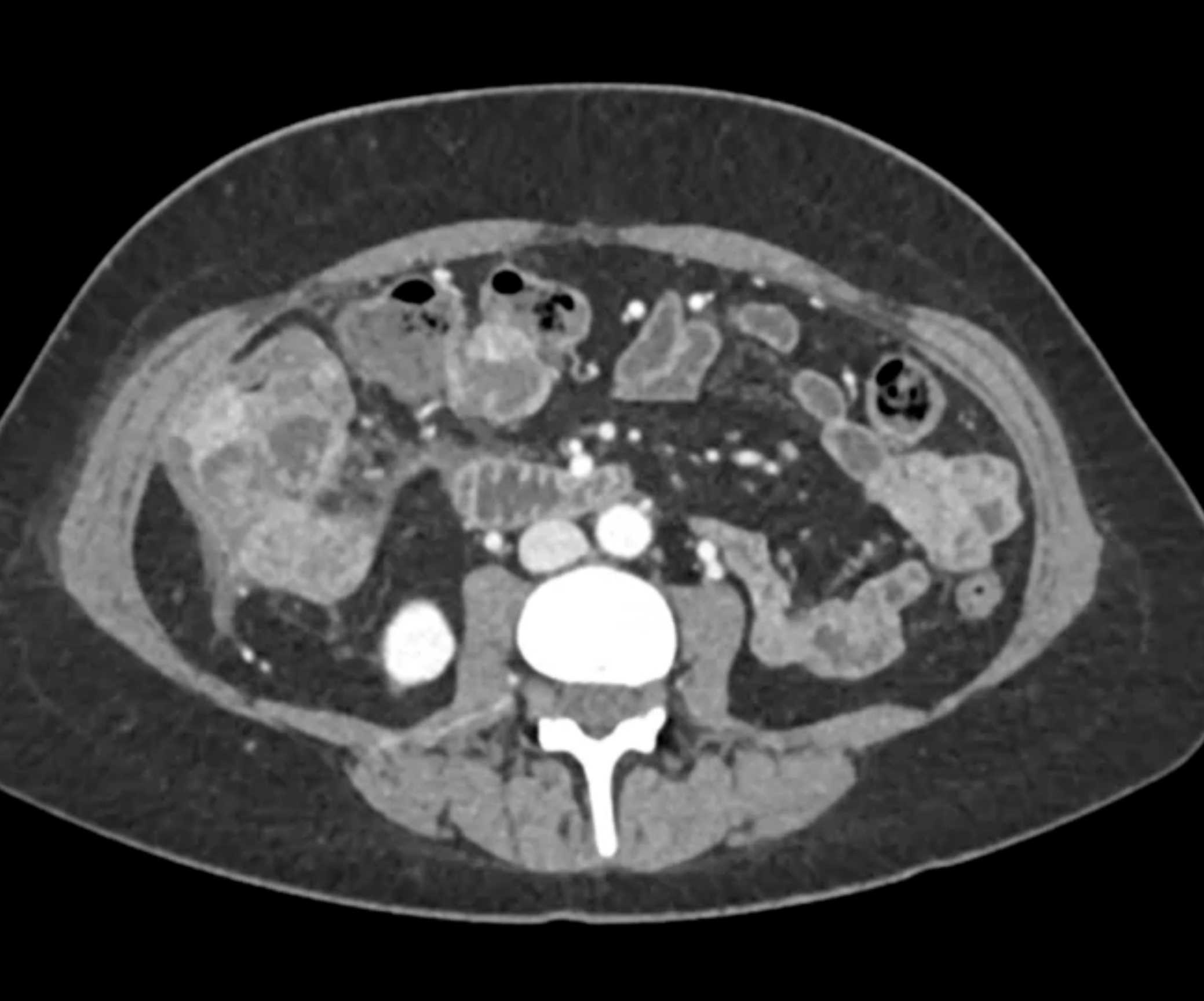 Adenocarcinoma Appendix with Liver Metastases and Implants - CTisus CT Scan