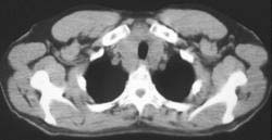 Thyroiditis - CTisus CT Scan