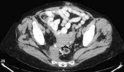 Recurrent Rectal Cancer - CTisus CT Scan
