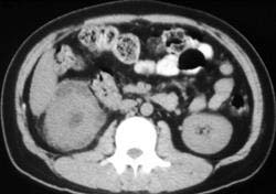 Acute Pyelonephritis With Pararenal Extravasation of Urine - CTisus CT Scan