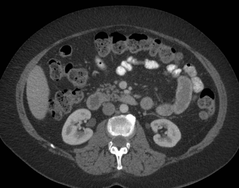 Small Bowel Adenocarcinoma with CT/PET Correlation - CTisus CT Scan
