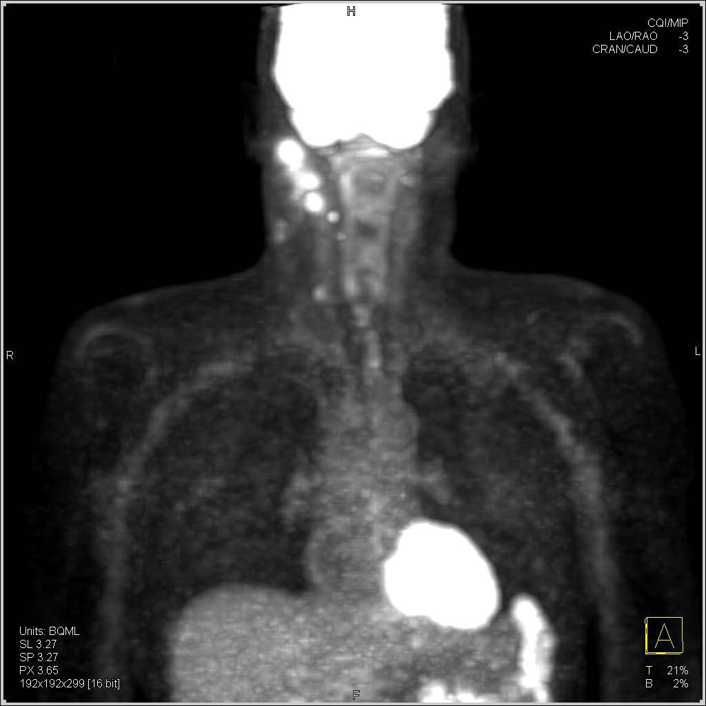 Adenopathy in Left Neck in Head and Neck Tumor Recurrence - CTisus CT Scan
