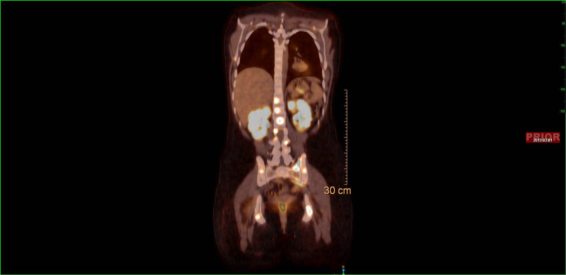 25 year old woman with atypical Burkett lymphoma.
Coronal fused PET/CT images show multifocal tumor throughout the skeletal system and diffuse lymphomatous infiltration of the kidneys - CTisus CT Scan