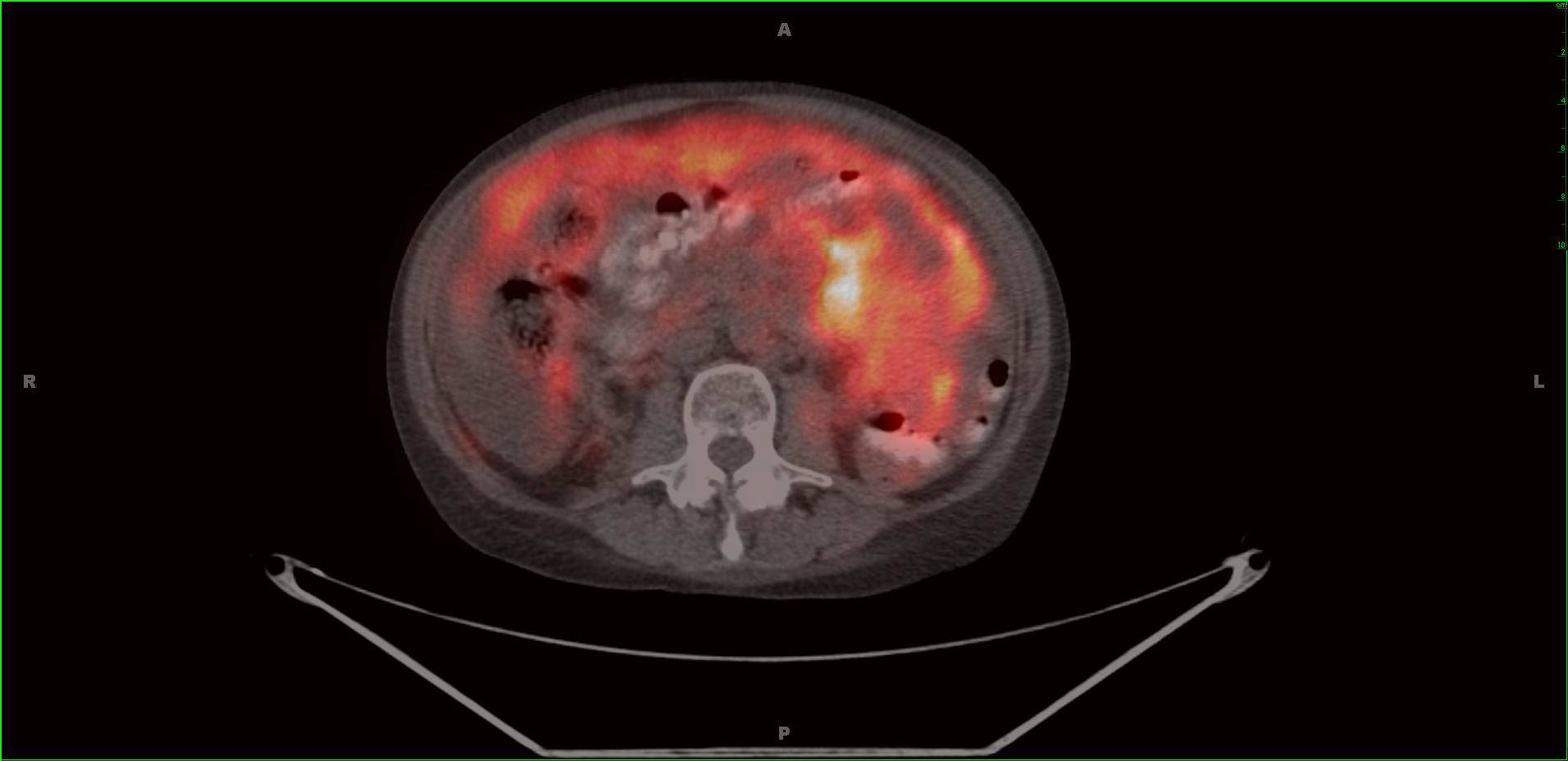 53 year old woman s/p renal transplant 15 years ago on cyclosporine and azithroprine. Elevated CA 125. CT showed adenopathy as well as induration of the mesentery and omentum. Axial fused PET/CT images demonstrate FDG avid adenopathy along the right heart - CTisus CT Scan