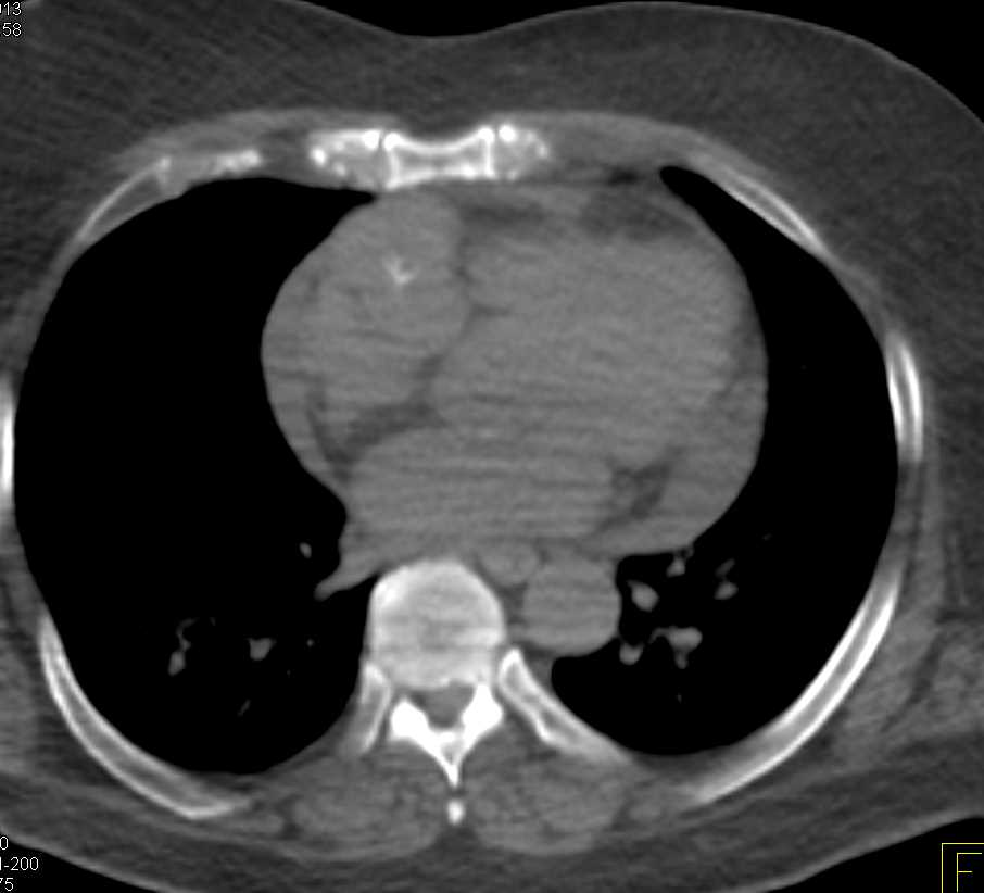 Cardiac Angiosarcoma - CTisus CT Scan