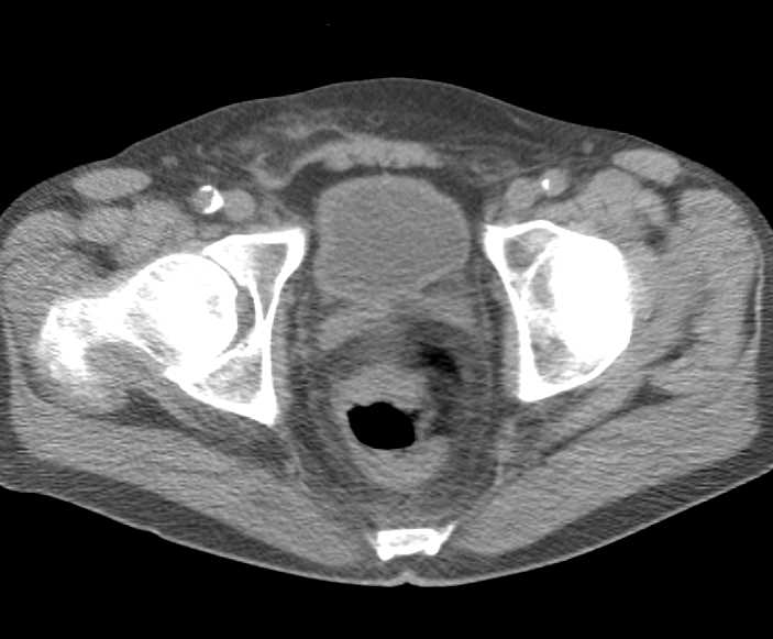 Rectal Cancer - CTisus CT Scan