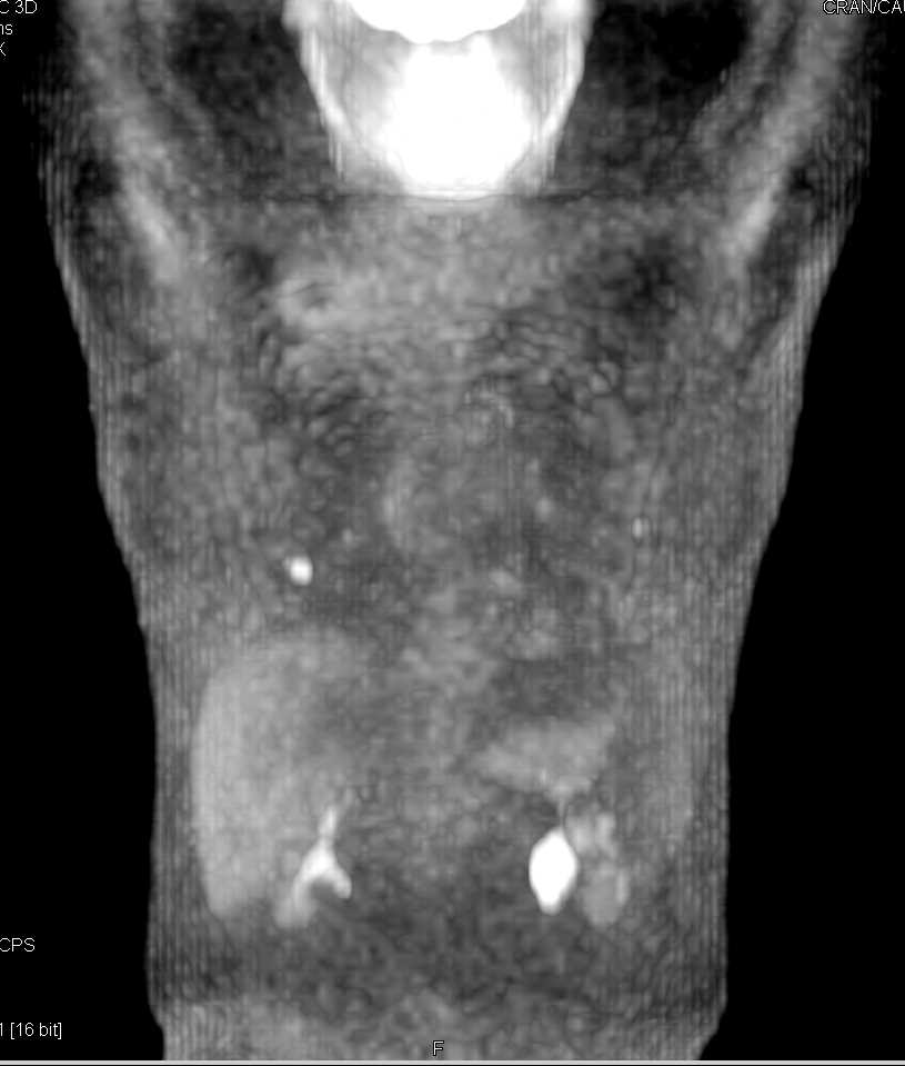 Rectal Cancer with Lung Metastases - CTisus CT Scan