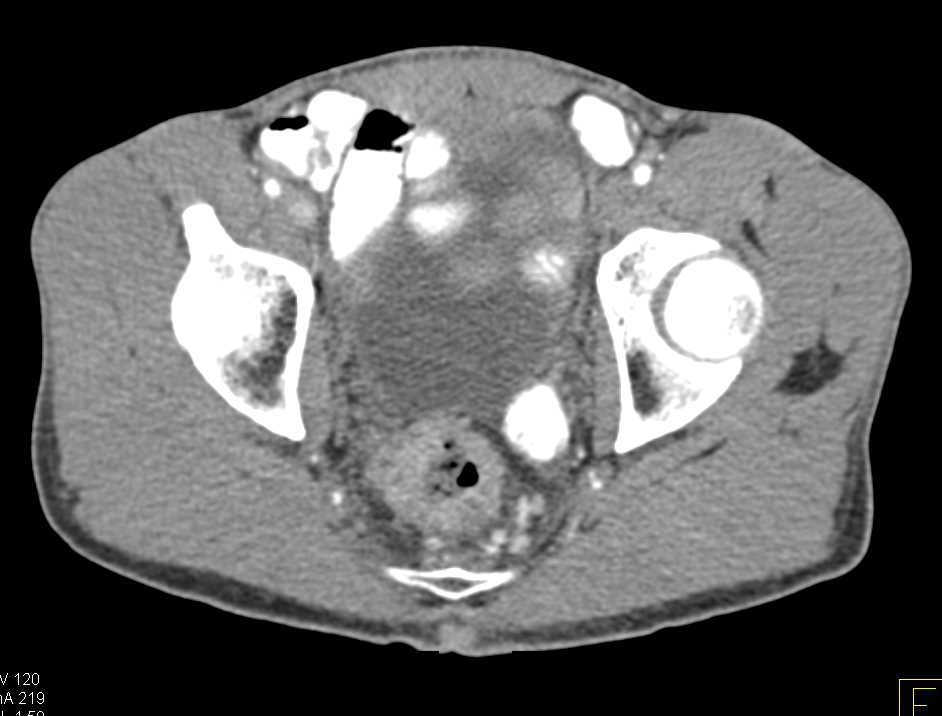 Bulky Rectal Cancer on PET/CT - CTisus CT Scan