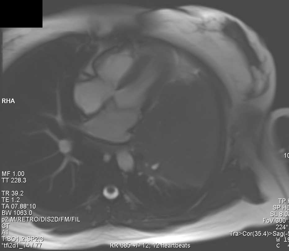 Lymphoma Left Chest Involves the Heart - CTisus CT Scan