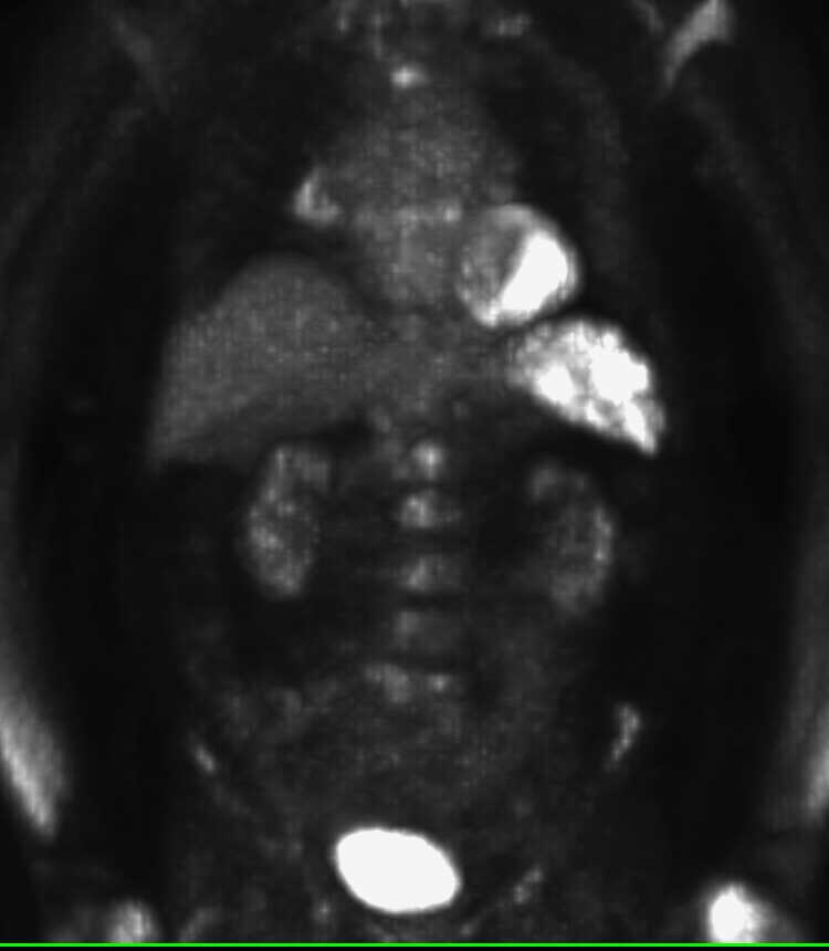PET/CT Positive for Metastatic Head and Neck Tumor - CTisus CT Scan