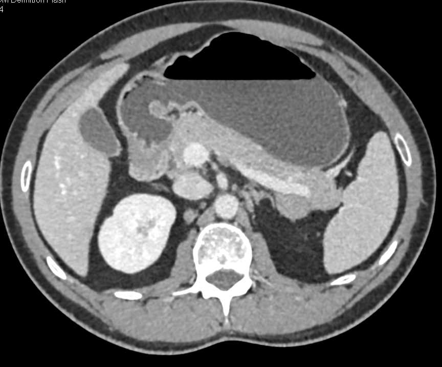 Gastric GIST Tumor - CTisus CT Scan