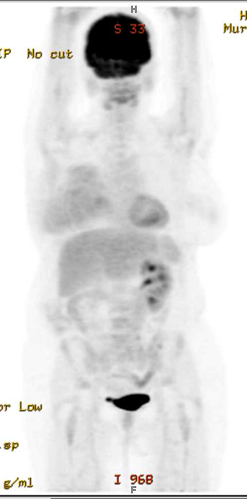 Solitary Kidney on a PET/CT - CTisus CT Scan