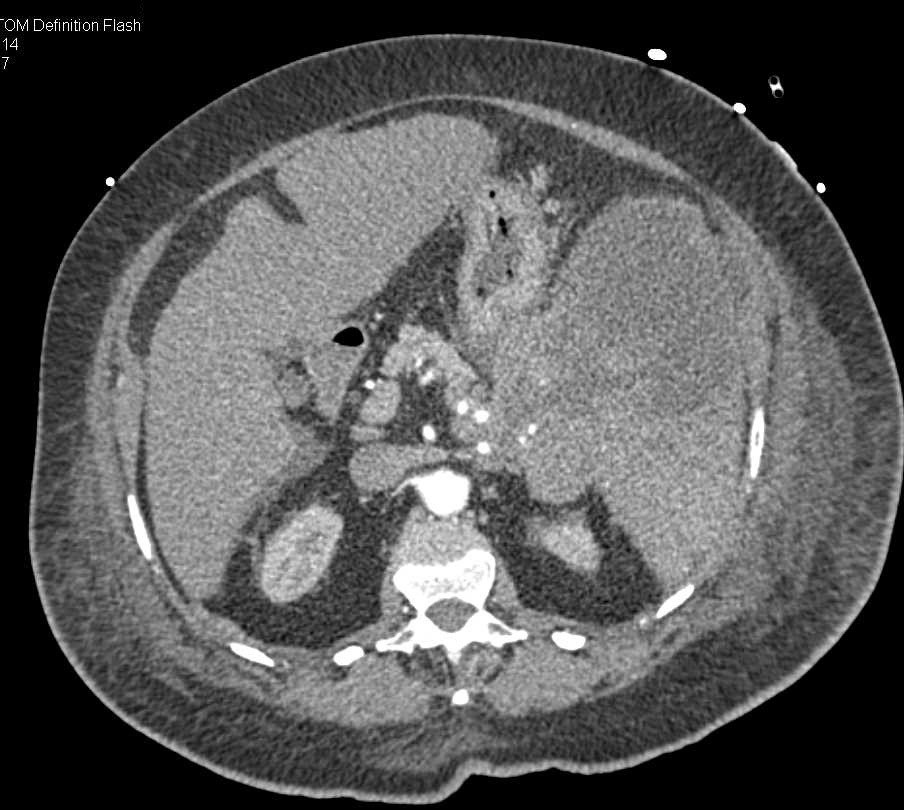 Splenic Lymphoma - CTisus CT Scan