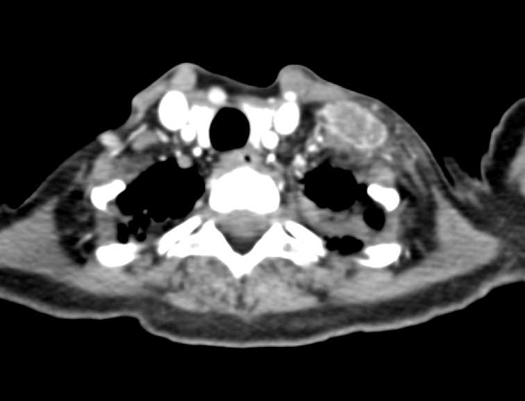 Left Upper Quadrant Sarcoma with Extensive Metastases on PET/CT - CTisus CT Scan