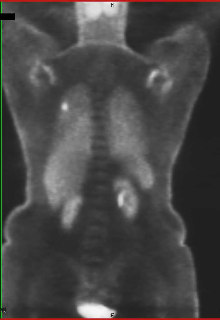 Right Upper Lobe Lung Cancer - CTisus CT Scan