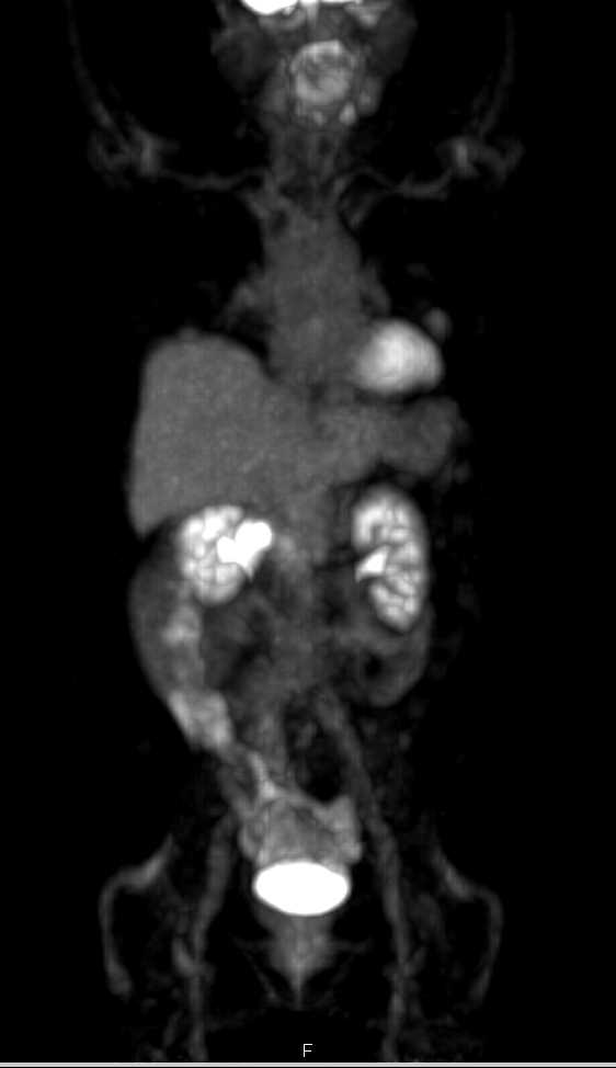 PET CT Shows no Recurrence in the Abdomen - CTisus CT Scan