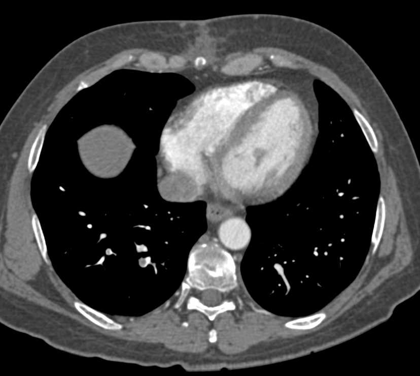 Pancreatic Cancer with Pulmonary Emboli (PEs) - CTisus CT Scan