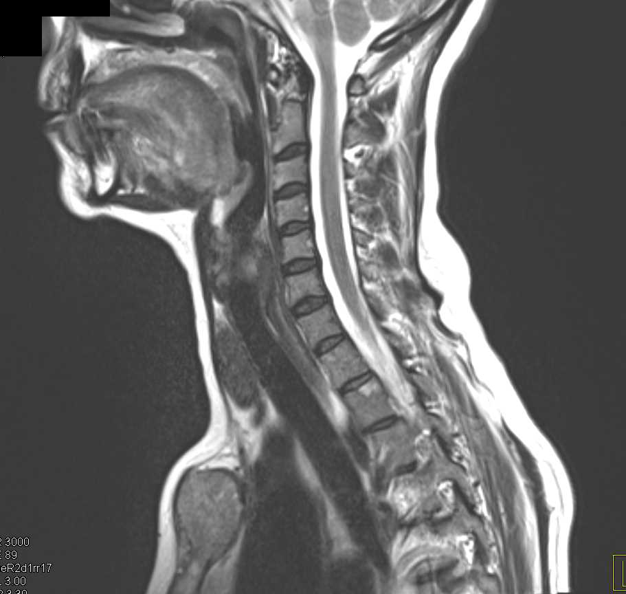 Metastatic Colon Cancer to Liver with Portal Adenopathy and Metastases to Sternum - CTisus CT Scan