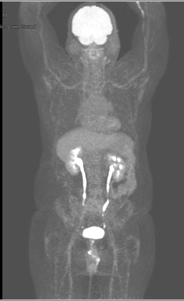 Transitional Cell Carcinoma Right Renal Pelvis - CTisus CT Scan