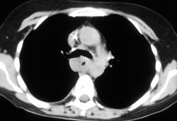 Esophageal Cancer - CTisus CT Scan
