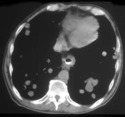 Esophageal Cancer W/lung Metastases - CTisus CT Scan